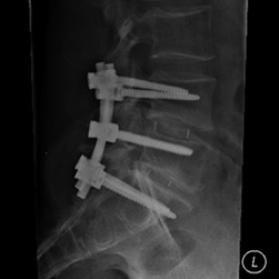x-ray pictures of lower spine