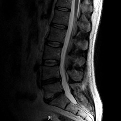 x-ray pictures of lower spine