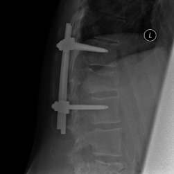 x-ray of L1 spine