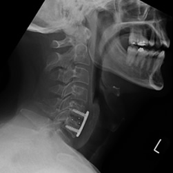 cervical x-ray