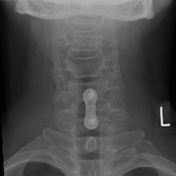 cervical x-ray